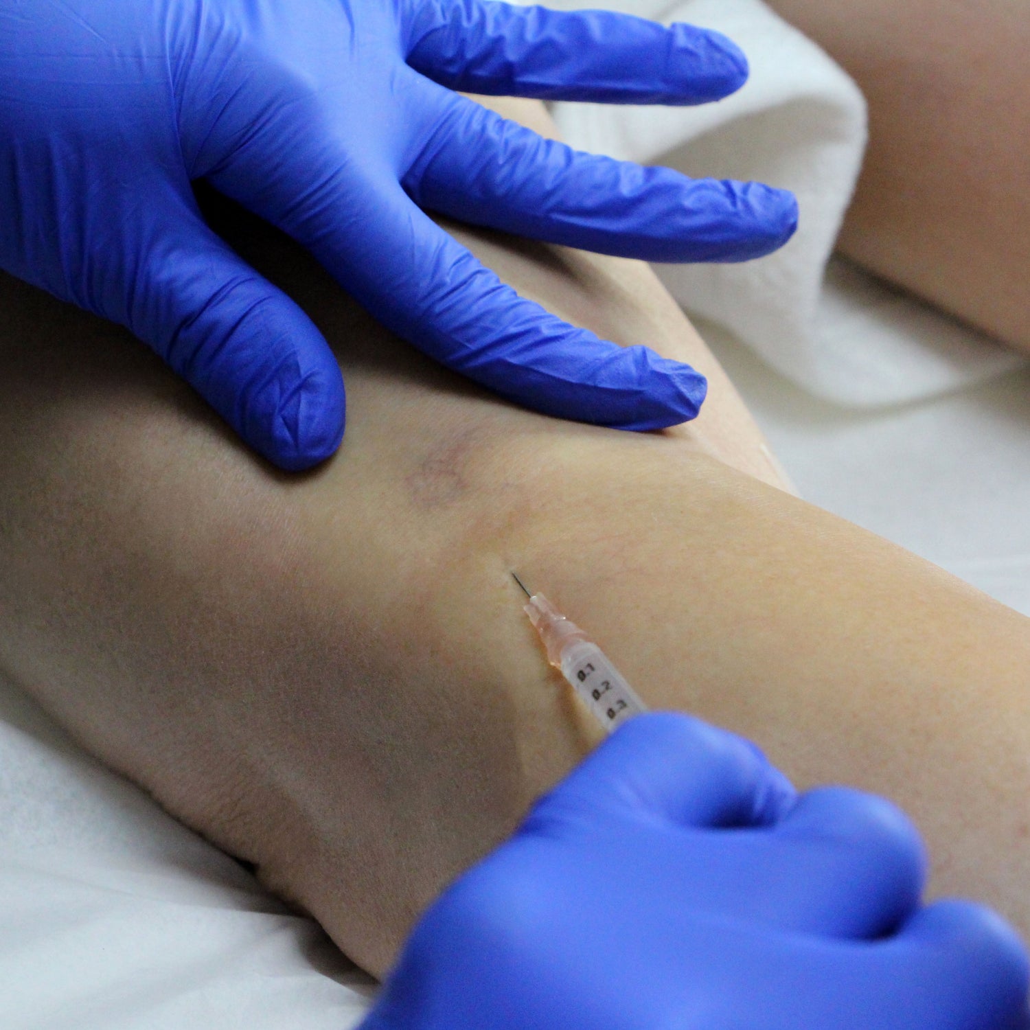 Traitement des varices