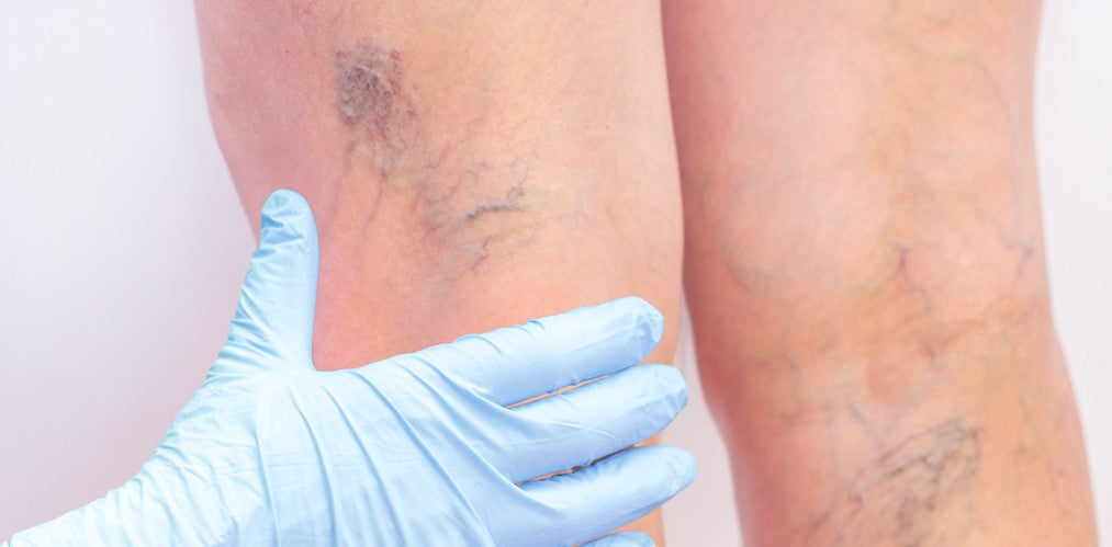 Traitement des varices à Montréal : soulagez vos jambes durablement