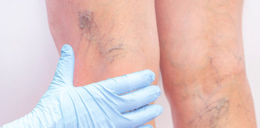 Traitement des varices à Montréal : soulagez vos jambes durablement