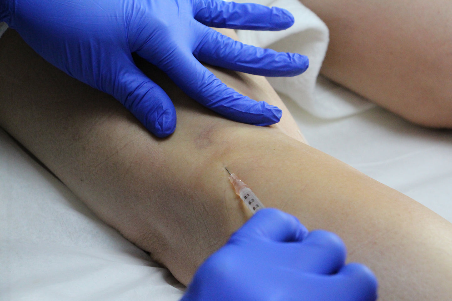 Traitement des varices